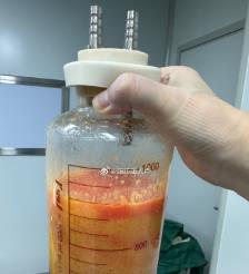 南充水动力吸脂手术要做多久？
